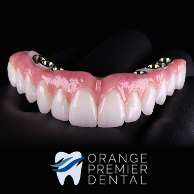 Hybrid Implant Bridge