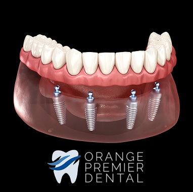 Zirconia Implant Bridge