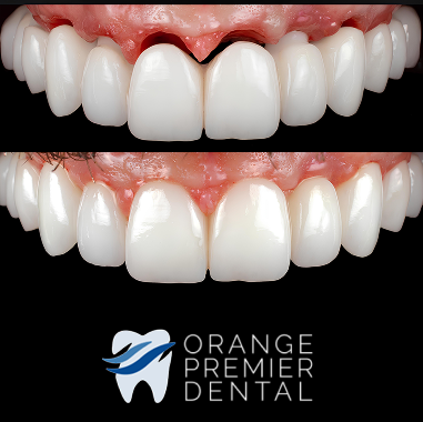 Porcelain Implant Bridge